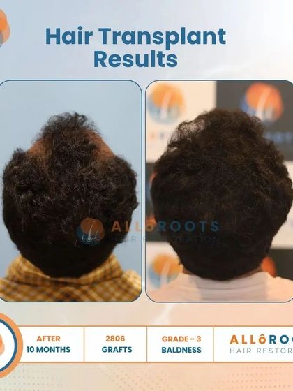This 10-month result for a Grade 3 baldness case, using 2806 grafts, showcases a significant improvement in density and a perfectly restored hairline from all angles.
