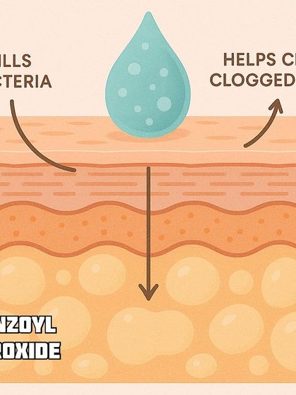 Benzoyl Peroxide is another effective ingredient for acne. This diagram shows how it works by killing bacteria and helping to clear clogged pores.