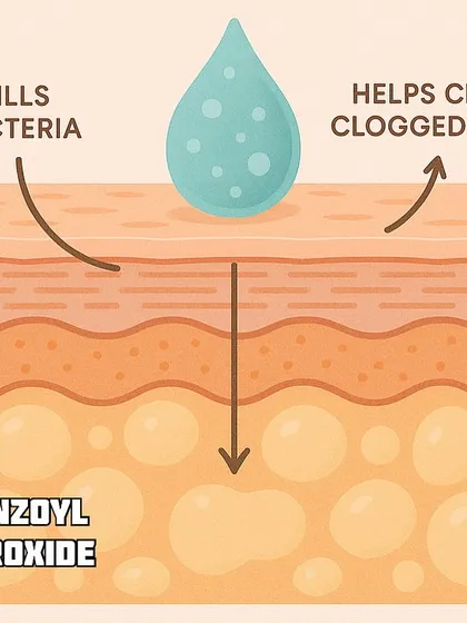 Benzoyl peroxide is another powerful tool against acne. It works by killing acne-causing bacteria and helping to clear clogged pores.