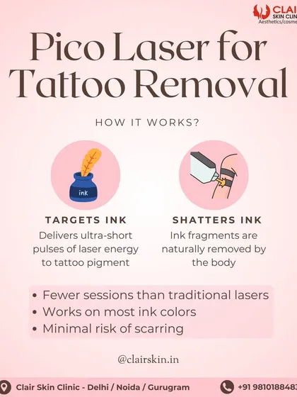This explains how our Pico Laser tattoo removal works. The laser delivers ultra-short energy pulses that specifically target and shatter ink particles, which are then naturally cleared by your body. This technology means fewer sessions and better results on most ink colors.
