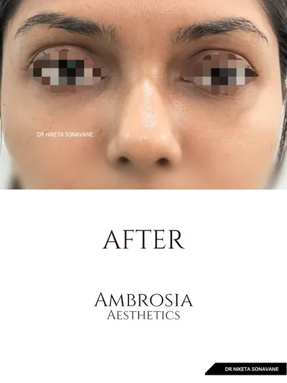This is the "after" shot, showing a significant improvement in the under-eye area. The hollows are filled, and the skin appears brighter and smoother, resulting in a much more rested and youthful look.