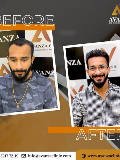 Confidence is just one hair transplant away. This client's new look, complete with a stylish beard and full head of hair, is a testament to that.