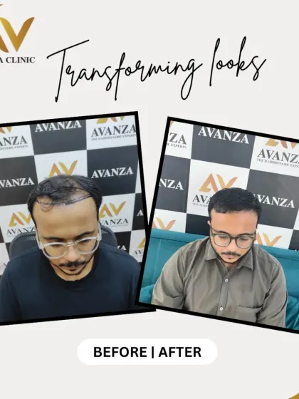 This client's transformation is a perfect example of restoring a strong, masculine hairline and adding density throughout the frontal region.