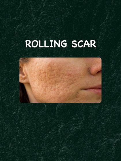 This image illustrates the appearance of rolling acne scars. A combination of treatments is often most effective for improving this type of texture.