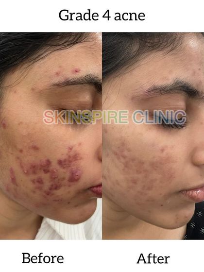 This is a case of Grade 4 acne, which involves deep, painful cysts. Our treatment significantly reduced the inflammation and number of lesions, providing much-needed relief and starting the journey toward scar revision.