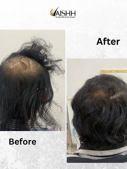 Treating crown alopecia requires a specific approach to create a natural whorl pattern. This before-and-after shows the 5-month result of a hair transplant focused on the crown area.
