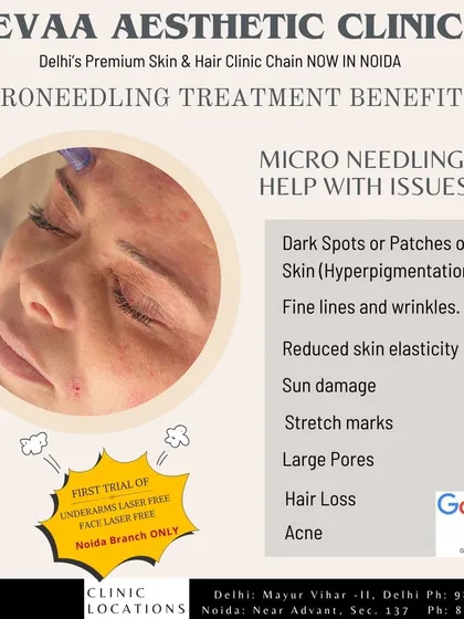 This graphic outlines the many benefits of microneedling. This treatment can help with issues like dark spots, fine lines, reduced skin elasticity, sun damage, and large pores.