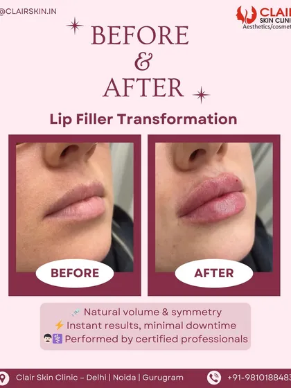 A beautiful example of our approach to lip fillers. The goal was to enhance natural volume and improve symmetry, resulting in beautifully defined lips that look balanced and feel authentic. This transformation was achieved instantly with minimal downtime.