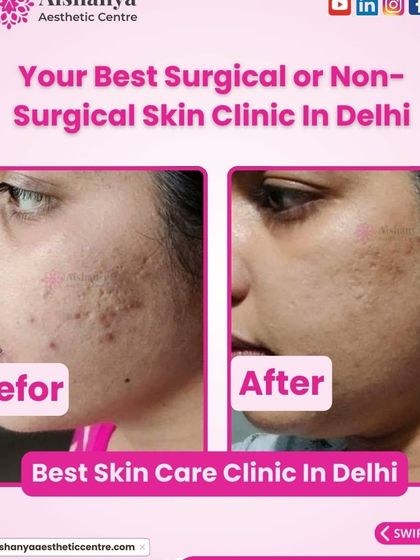 Here, you can see the successful treatment of deep, pitted acne scars. Using advanced procedures, we smoothed the skin's surface and stimulated collagen to fill in the indentations, resulting in a much more even texture.