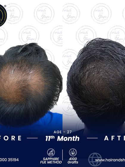 The crown area is often a major concern. This result after 11 months shows how we successfully restored hair to the crown, blending it seamlessly with the rest of his hair.