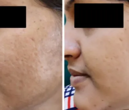 This patient's results show a significant improvement in both skin texture and post-inflammatory hyperpigmentation after a series of customized laser and peel treatments for acne scars.