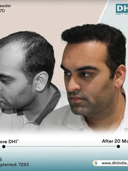 A before and after of a 26-year-old client 20 months post-transplant. With 7,253 hairs implanted, this long-term result shows the lasting density and natural look achieved with DHI.