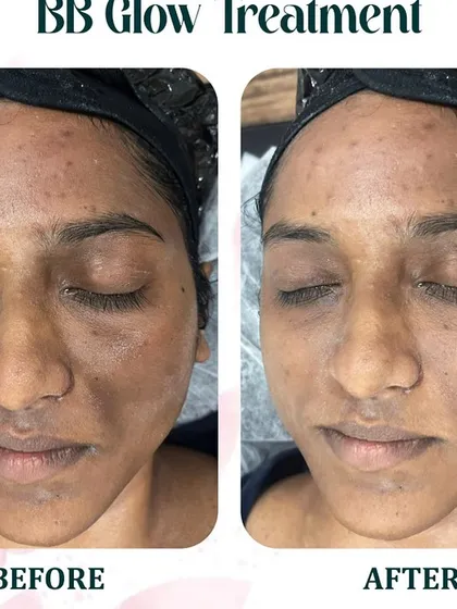 See the immediate transformation with our BB Glow treatment. This client wanted to address uneven skin tone and blemishes. The 'after' photo shows how the semi-permanent serum provides light coverage, reduces redness, and creates a flawless, dewy finish.
