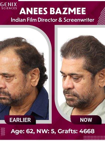 A complete view of Director Anees Bazmee's transformation from all angles, showing the density and natural hairline we created.