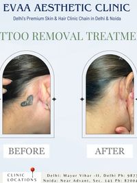 Laser Treatments