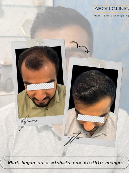 What starts as a wish for better hair becomes a visible reality at our clinic. This before-and-after showcases a significant increase in hair density.