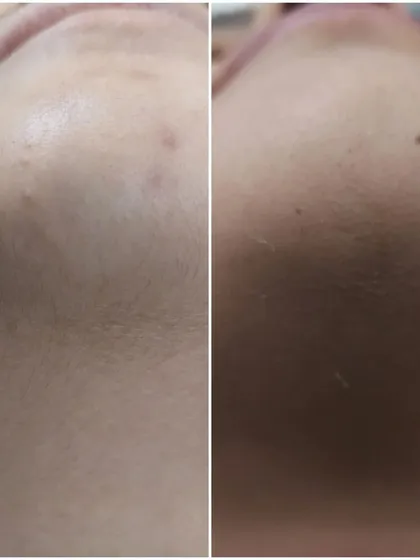See the instant results of a dermaplaning facial. The 'after' image on the right shows a visible reduction in fine vellus hair and dead skin cells, resulting in a smoother, brighter complexion on the patient's chin and jawline.