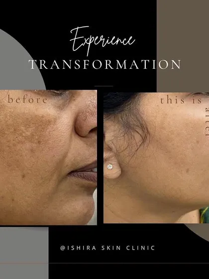 Treating melasma requires a careful and consistent approach. This result shows a dramatic reduction in hyperpigmentation, leading to a clearer and more even skin tone for my patient.