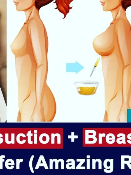 This graphic illustrates a procedure where we use the patient's own fat, removed via liposuction from one area, and transfer it to the breasts. This is a natural alternative to implants for enhancing breast volume as part of a body contouring plan.