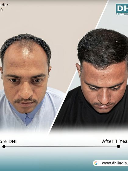 A top-down view of a 37-year-old patient one year after his procedure. With 4,327 hairs implanted, his hair is now dense and full, a testament to the lasting results of DHI.