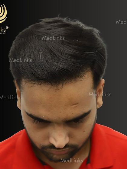 The top-down view after the transplant, showcasing the full coverage achieved.