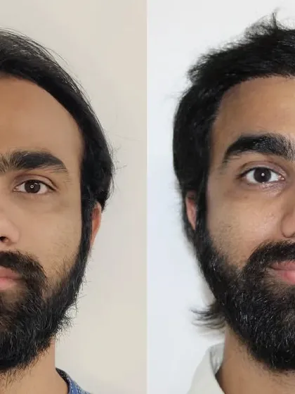This is a perfect example of a complete transformation. We addressed both the receding hairline and the thinning on top. By carefully designing the hairline and ensuring high-density packing, the final result is seamless and looks like he never lost any hair at all.