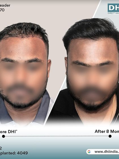 A frontal before and after of the same client at the 8-month mark. The significant improvement in coverage and density highlights the effectiveness of our DHI procedure for a more youthful look.