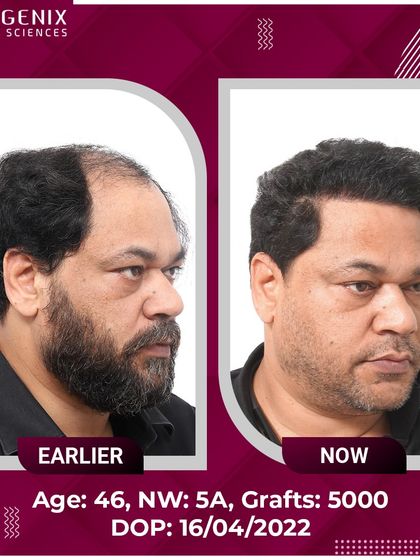 A remarkable 5000-graft transformation for a 46-year-old patient with Grade 5A baldness.