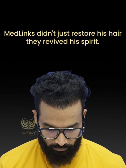 The final result for Abhilash. We didn't just restore his hair; we revived his spirit.