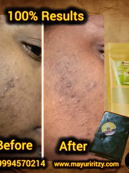 This before and after image shows the powerful effect of my Acne & Pores kit. You can see a significant reduction in acne and a clearer complexion. My face pack and soap work together to tackle breakouts and give you 100% results.
