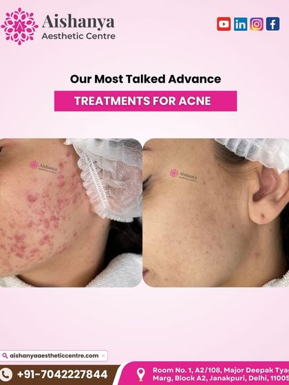 This before-and-after of acne treatment shows a dramatic reduction in inflammation and breakouts. My approach is to create a personalized plan that not only clears current acne but also prevents future flare-ups.