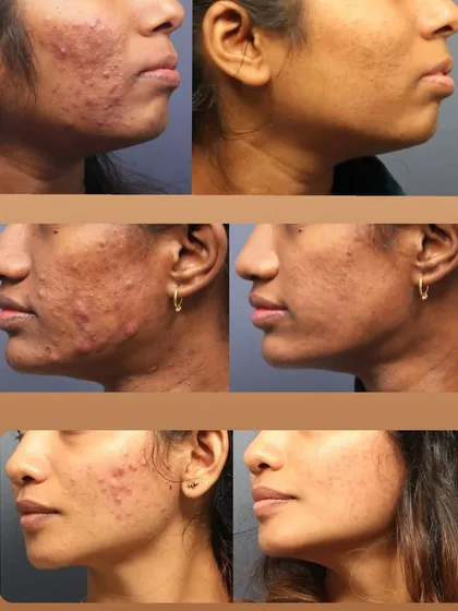 A Life-Changing Acne Transformation. This before-and-after gallery shows the journey from severe, painful acne to clear, healthy skin. My approach combines medical diagnosis with a personalized treatment plan to not only clear active breakouts but also improve skin texture and confidence.