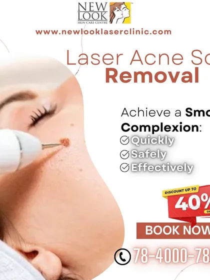 We are committed to making clear skin accessible. This image shows a laser acne scar removal procedure, a safe and effective method for achieving a smooth complexion by targeting scar tissue and stimulating healing. We often have special programs to help you start your journey.