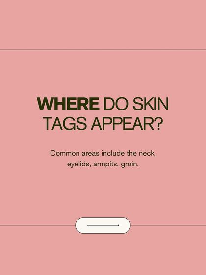 Where do skin tags commonly appear? They are often found on the neck, eyelids, armpits, and groin areas where skin rubs against skin or clothing.