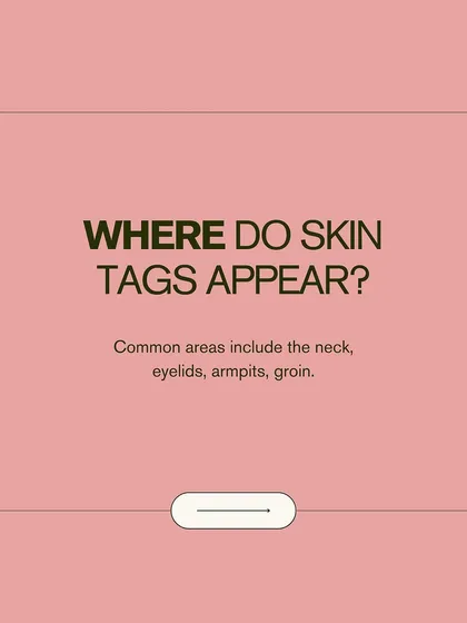 Where do skin tags commonly appear? They are often found on the neck, eyelids, armpits, and groin areas where skin rubs against skin or clothing.