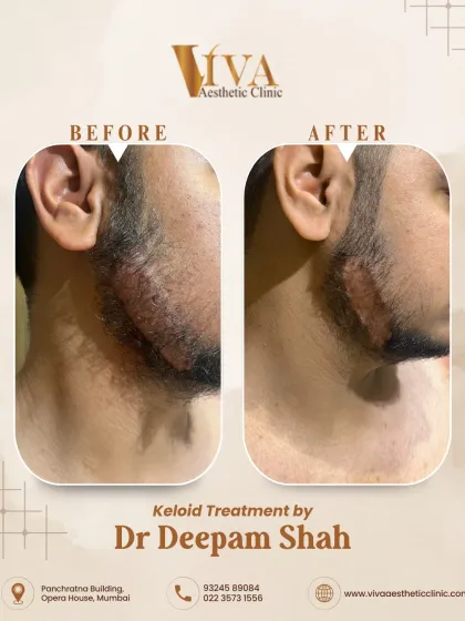 Treating keloids on the face and neck requires a delicate, precise approach. This patient had a prominent keloid along his jawline. We used a combination therapy to carefully flatten and soften the scar tissue over a few sessions, significantly improving its appearance and texture.