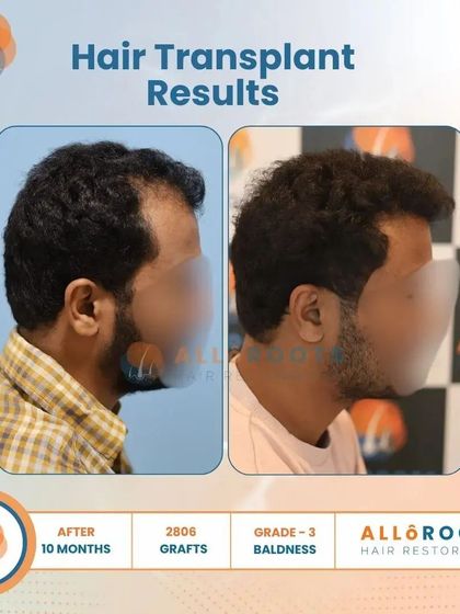 This 10-month result for a Grade 3 baldness case, using 2806 grafts, showcases a significant improvement in density and a perfectly restored hairline from all angles.