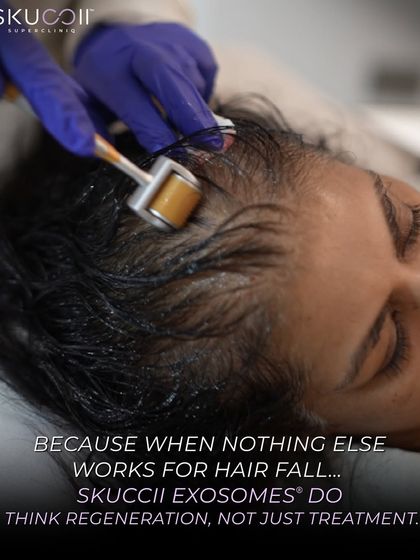 This close-up shows the application of Skuccii Exosomes using a derma roller. This technique creates micro-channels in the scalp, allowing the powerful regenerative signals to penetrate deeply and effectively awaken dormant hair follicles.