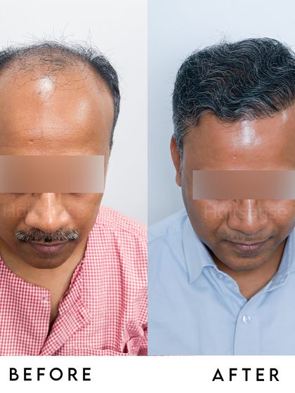 This top-down perspective provides a clear look at the density achieved in the crown area, one of the most common areas of concern for male pattern baldness.