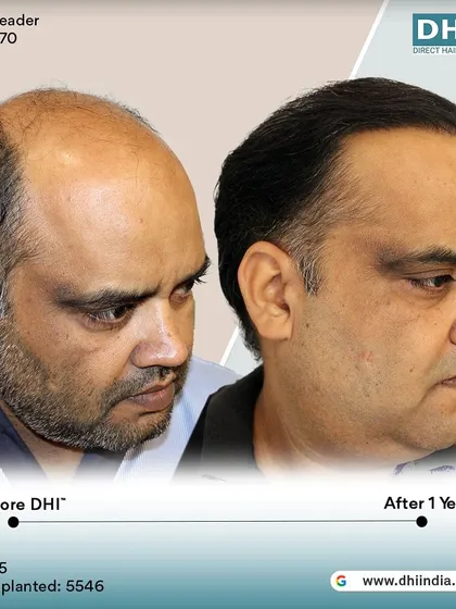 A before and after of a 45-year-old client one year after his procedure. With 5,546 hairs implanted, his scalp is now fully covered with dense, natural-looking hair.