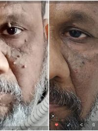 Mole, Wart & Skin Tag Removal