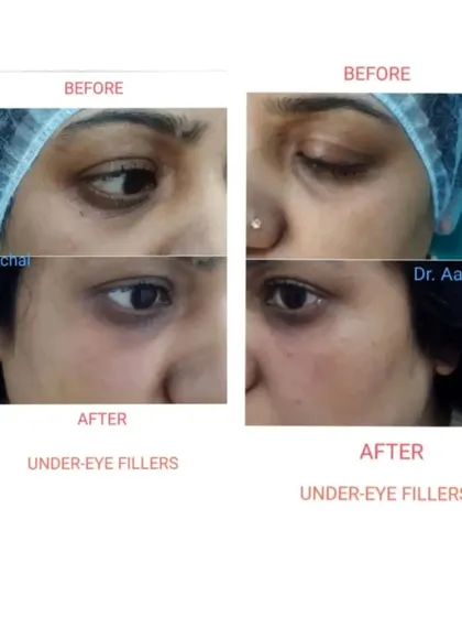 Two successful examples of non-surgical under-eye correction using dermal fillers. Both before-and-after sets show a visible improvement in hollowness and dark circles, leading to a brighter and less tired look.