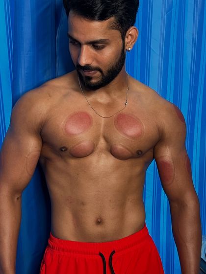 A close-up of the cupping marks on Saifaan Khan's chest.
