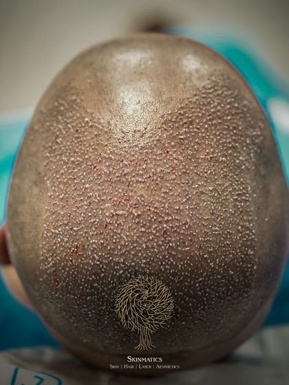 Skinmatics - Hair Restoration The FUE Transplant Process: A Step-by-Step Look photo 17