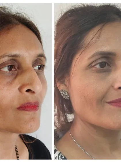 A closer look at the results of our Organic Lift treatment. This transformation was achieved using a gel made from the client's own blood to naturally restore volume and smooth the skin around the eyes.