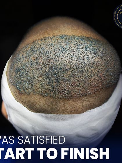 This image captures the full scope of a frontal hair transplant immediately after the session. The area is clean, and the placement is uniform, setting the stage for successful growth and a satisfying result from start to finish.