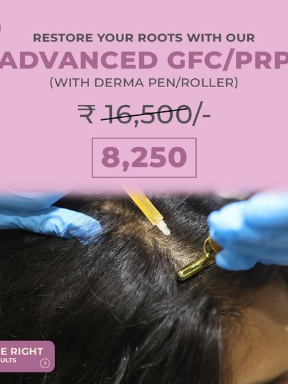 This image shows the precise application of our Advanced GFC/PRP treatment using a derma pen. This technique enhances the absorption of growth factors directly into the scalp for more effective root restoration.