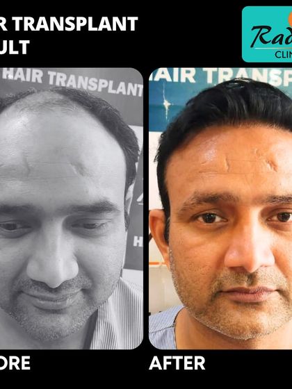 A powerful transformation for a patient with advanced hair loss. The 'after' photo shows a full head of hair, demonstrating the effectiveness of a comprehensive hair transplant plan.