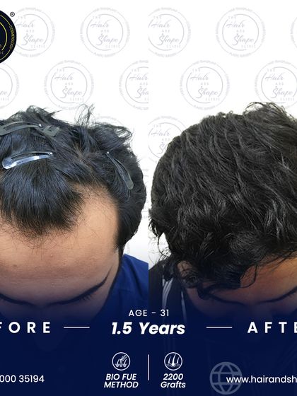 1.5 years can make a world of difference. This result from a 2200-graft BIO FUE procedure shows long-lasting, natural density.