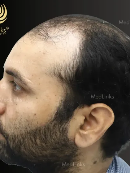 A side view of the patient's hair loss before the procedure. This is a crucial angle for designing a hairline that will stand the test of time.
